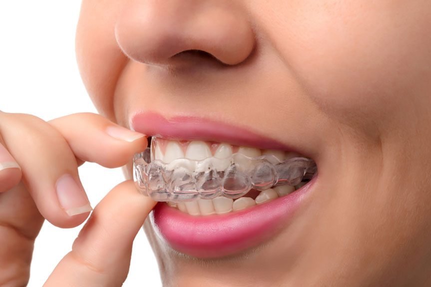 Invisalign Treatment Duration Demystified: Tips and Advice for Planning